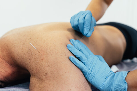 DRY NEEDLING : TOP30